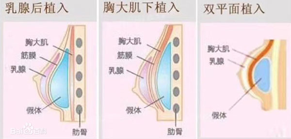 双平面假体隆胸