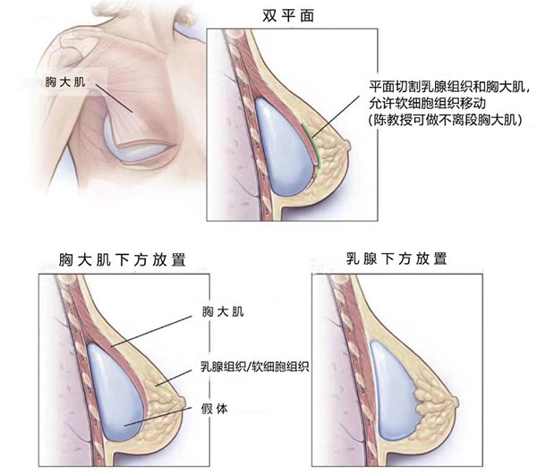 双平面假体隆胸