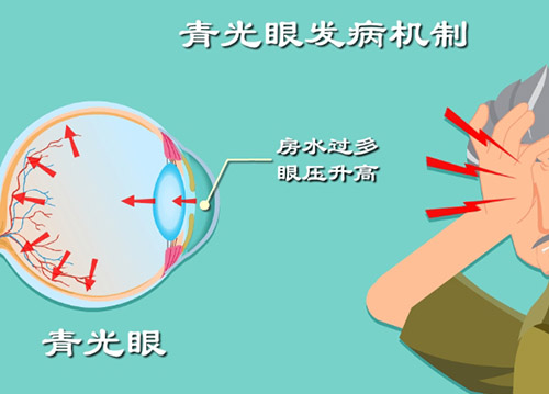 青光眼的发病机制