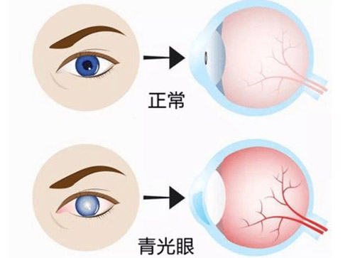 青光眼的症状表现