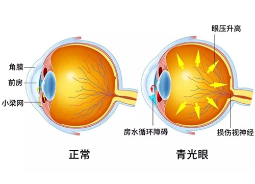 青光眼可以治好吗