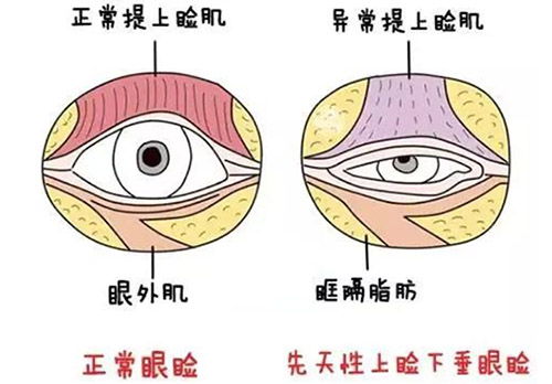 上睑下垂对比图片