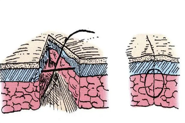 皮内逐层缝合