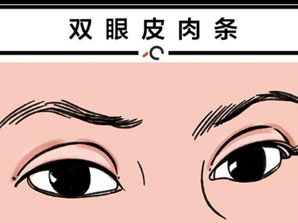 肉条感双眼皮如何修复