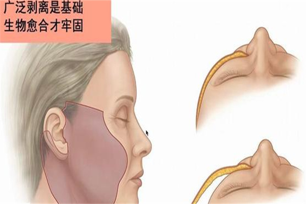 北京十优李晓东医生拉皮手术