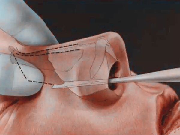 全肋骨鼻和半肋骨鼻哪个好