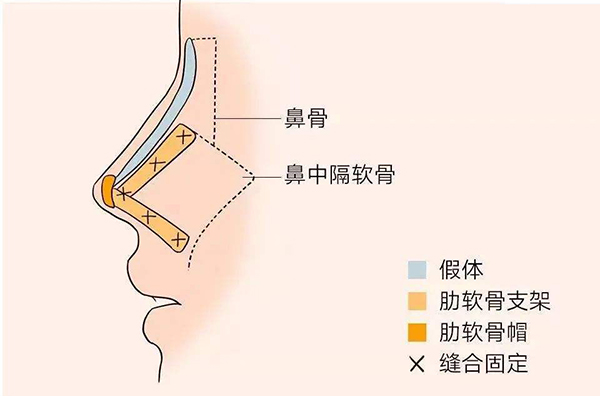 全肋和半肋隆鼻有什么区别