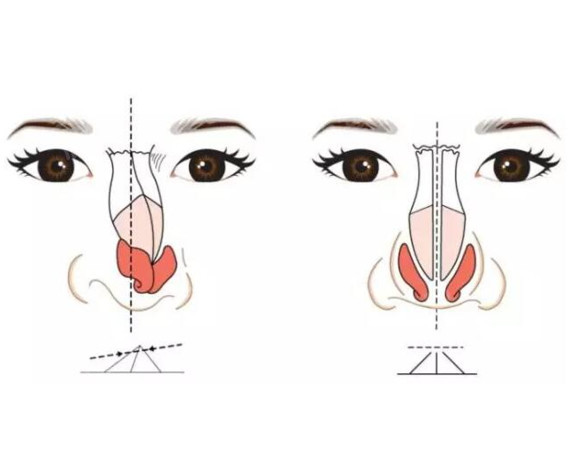 全肋和半肋隆鼻有什么区别
