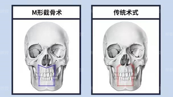 反颌矫正术哪个医院做得好