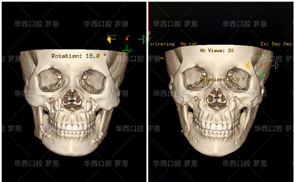 反颌矫正术哪个医院做得好