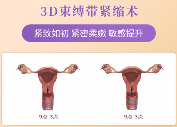 3d生物束带紧缩术后真的有效吗