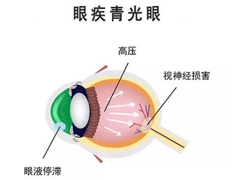 如何判断自己得了青光眼