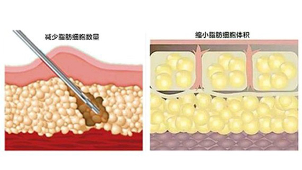 水动力吸脂和负压吸脂哪个好