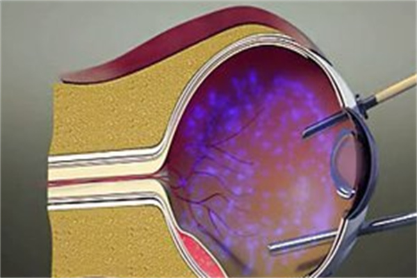 玻璃体切除术图片