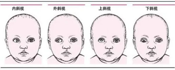 斜视手术一般多少钱