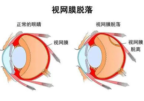 视网膜脱落对比
