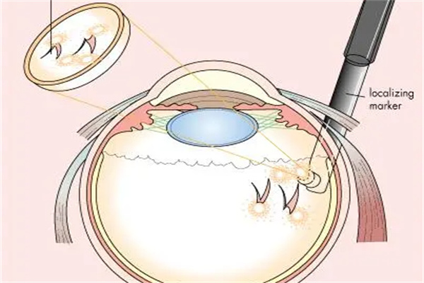 虹膜加固手术切口