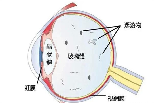 虹膜加固术适应症