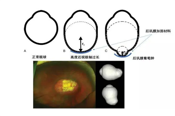 虹膜加固术原理