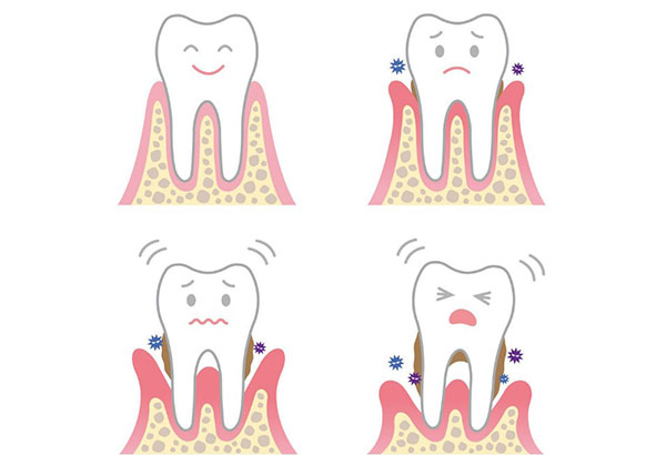 牙周炎的四大症状包括哪些