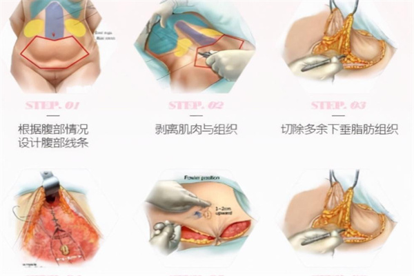 腹壁成型手术步骤