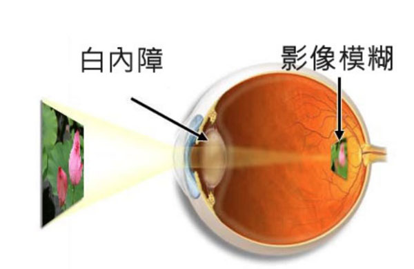 白内障手术大概需要多少钱