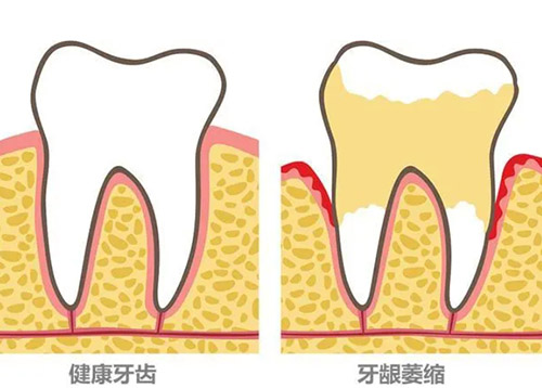 牙龈萎缩牙根外露怎么修复