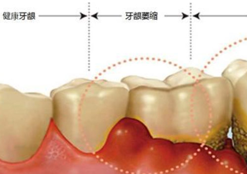 牙龈萎缩症状