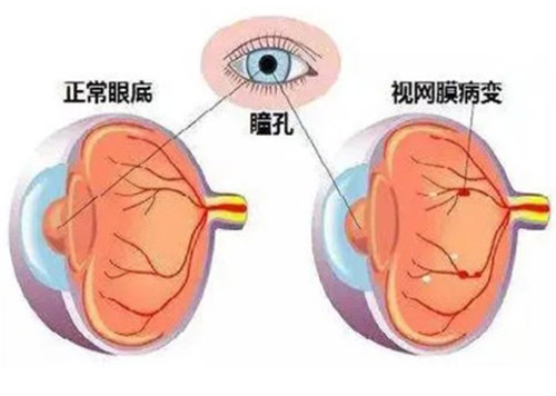 视网膜色斑病变图片