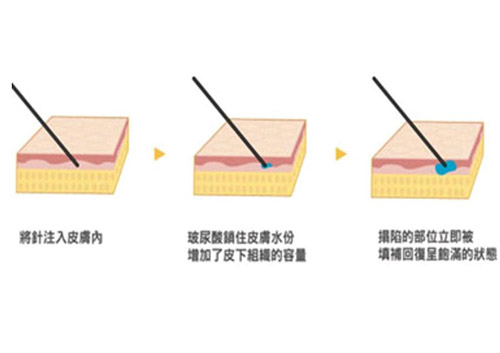 玻尿酸填充过程