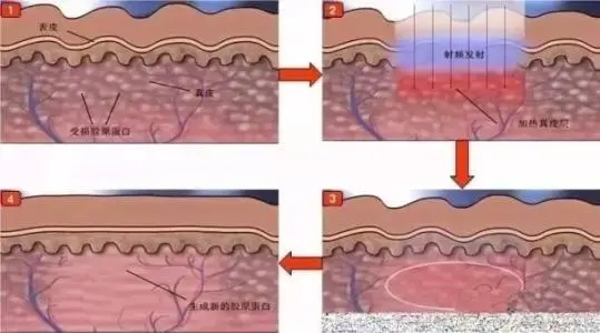 什么时候才能看到彩光嫩肤的成果?