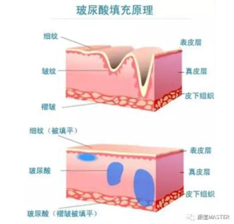 线雕和玻尿酸哪个好？