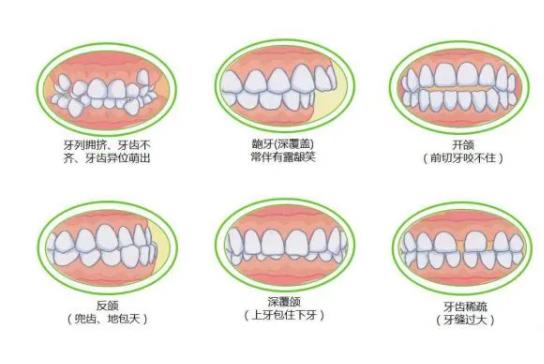 牙套需要戴多长时间才能取下？