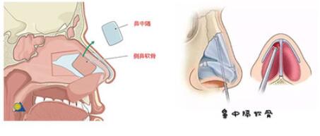 谢福庚做鼻子怎么样？技术优势、手术风格、隆鼻对比图