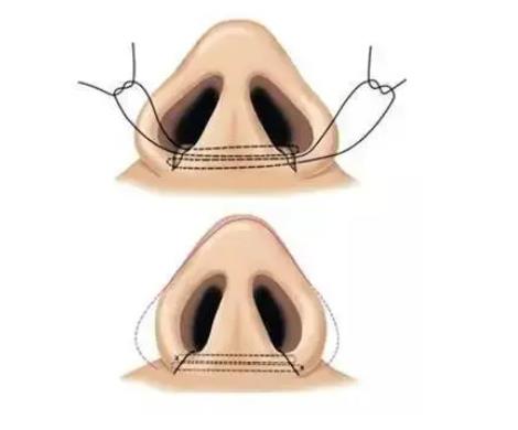 鼻头缩小修复期很长的原因是什么?
