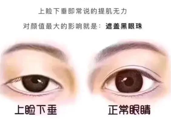 眼睑下垂去医院看什么科呢?