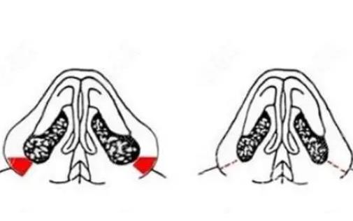 垫鼻基底的切口在什么地方