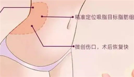 腰腹吸脂术的成果如何？