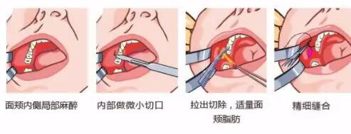 去颊脂垫修复时间大概要多久？术前术后注意事项建议你了解清楚再说~