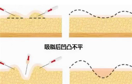 抽脂之后会不会有凹凸不平出现?