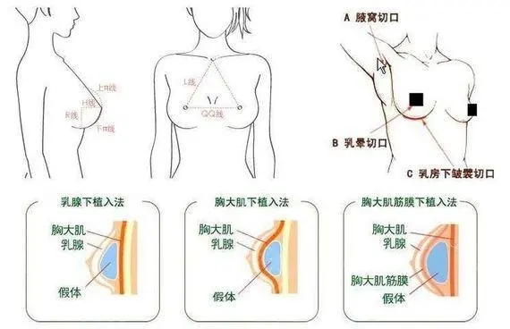 垂直双蒂法缩小乳房怎么样?操作后的注意事项