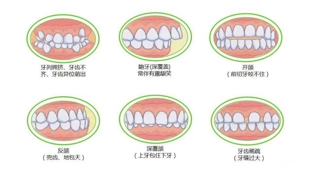 龅牙如何矫正,有哪些方法?