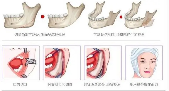 下颌角整形后的修复期有多长?注意事项有哪些?