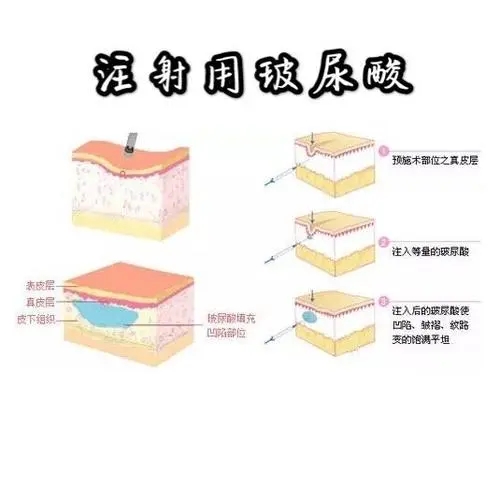 注射玻尿酸会肿吗?