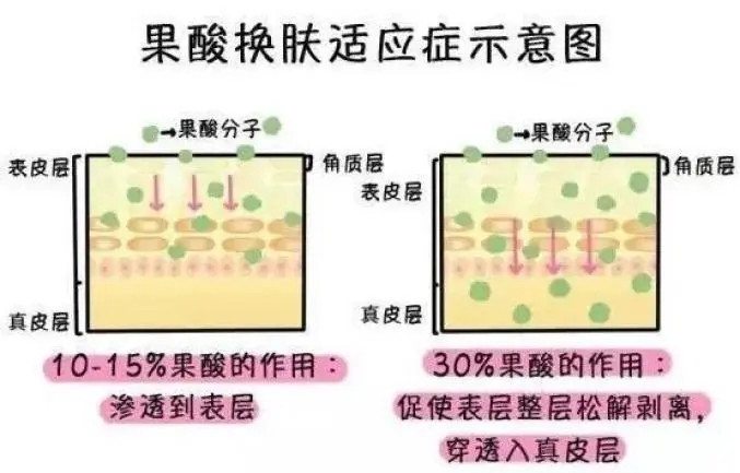 果酸换肤多少钱一次?贵吗?