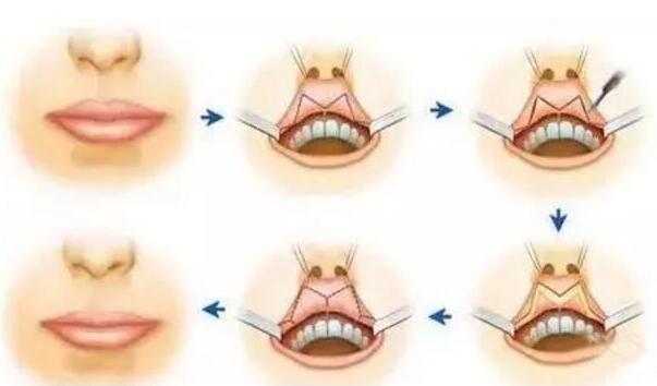 矫正重唇手术后需要注意什么?
