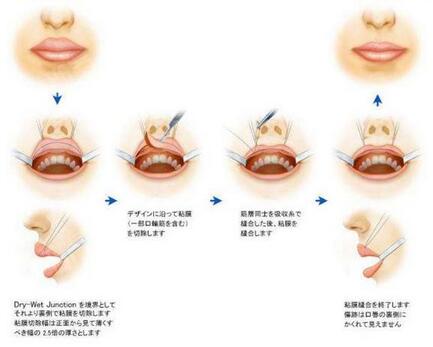 重唇修正的过程是什么? 重唇术后矫正切除缝合的注意事项有哪些?