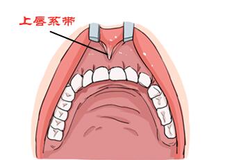 唇系带断裂能自己愈合吗?