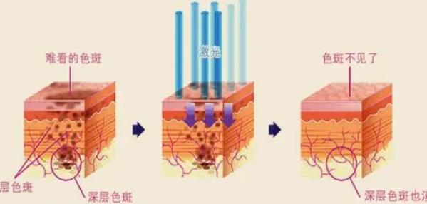 做皮秒后的注意事项