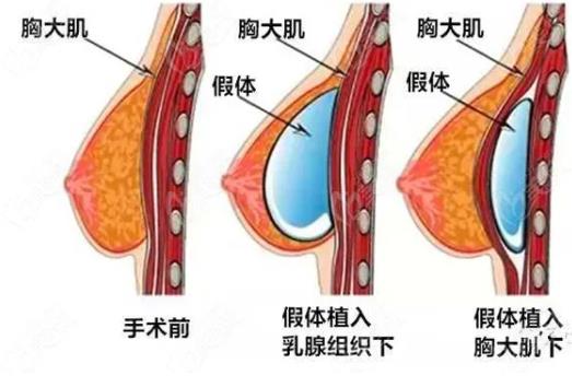 假体丰胸的切口在哪里?三种切口类型特点分析